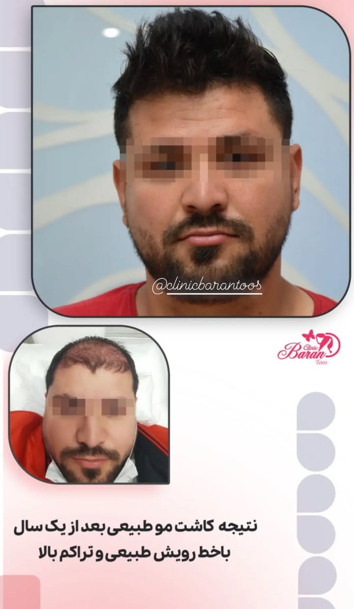 قبل و بعد کاشت مو با خط رویش طبیعی و استاندارد